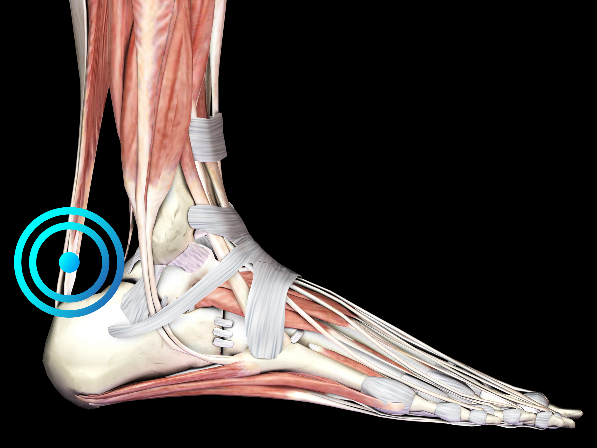 Achilles store tendonitis inserts